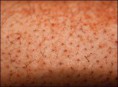 /album/fotogaleria/escorbuto-por-avitaminosis-c-jpg/